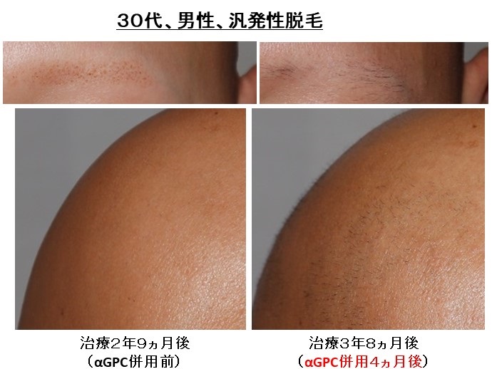 円形脱毛症　病院
